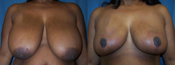 Before & After Breast Reduction Case 2840 View 1 View in Virginia Beach, VA