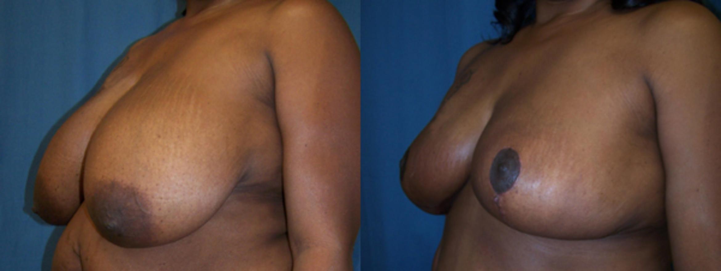 Before & After Breast Reduction Case 2840 View 2 View in Virginia Beach, VA
