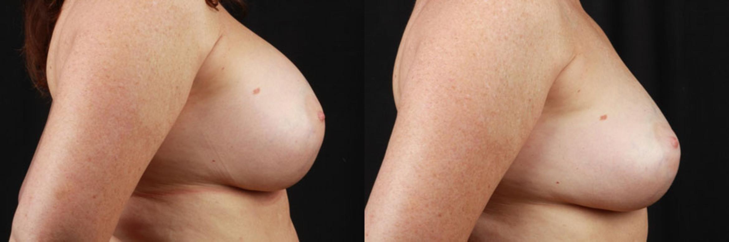Before & After Breast Reduction Case 4136 View 1 View in Virginia Beach, VA