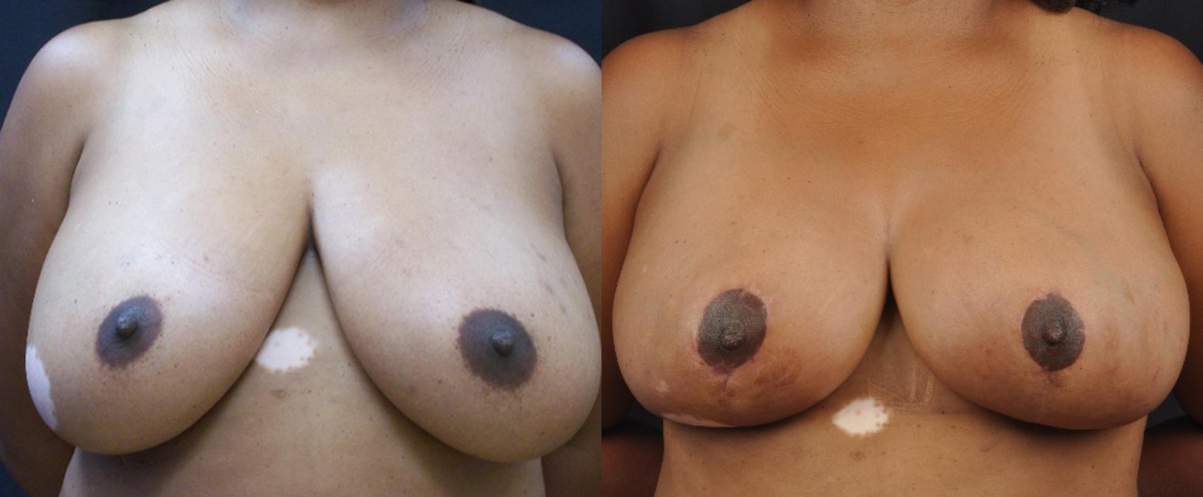 Before & After Breast Reduction Case 4418 View 1 View in Virginia Beach, VA