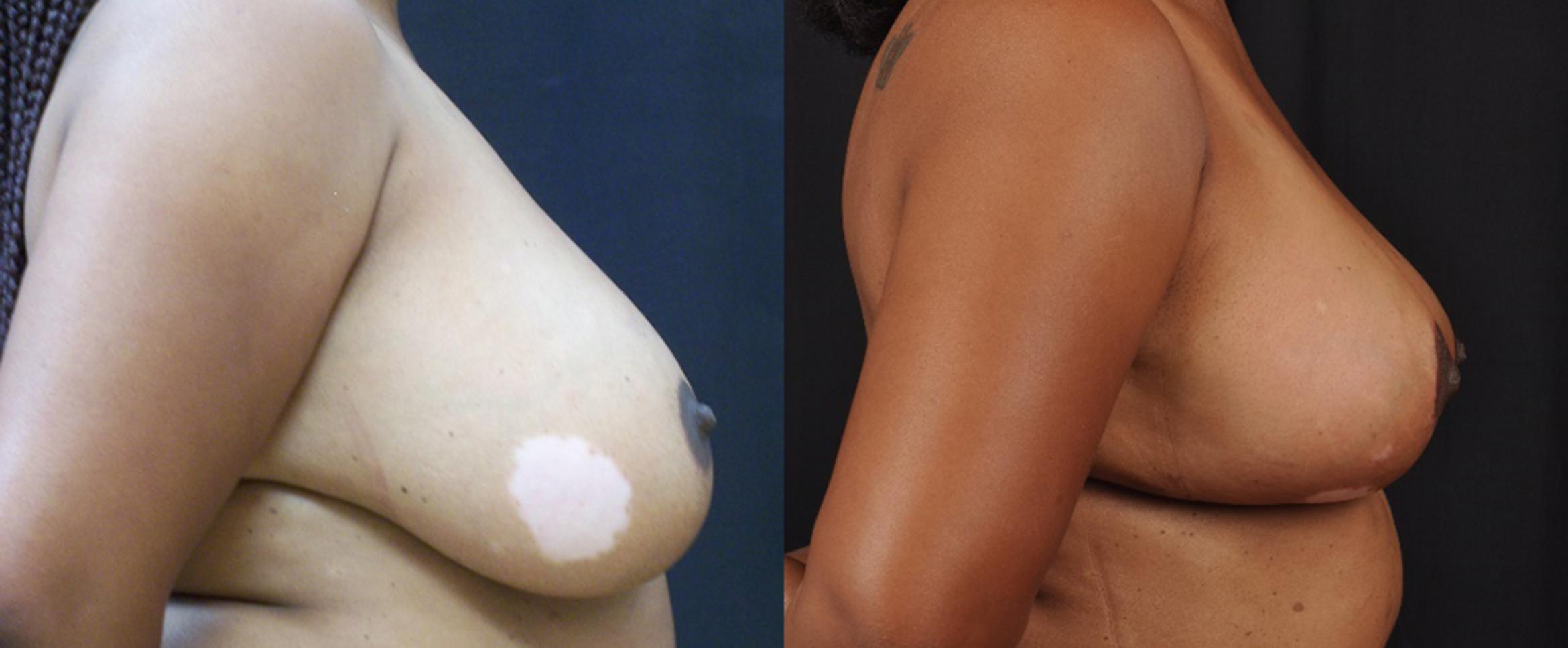 Before & After Breast Reduction Case 4418 View 2 View in Virginia Beach, VA
