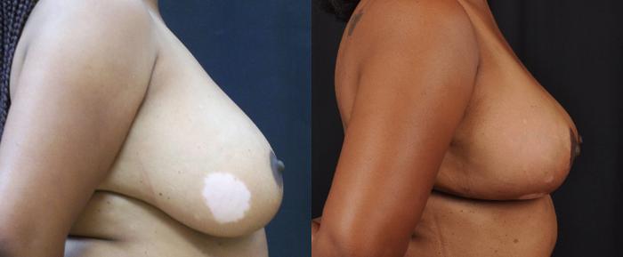 Before & After Breast Reduction Case 4418 View 2 View in Virginia Beach, VA