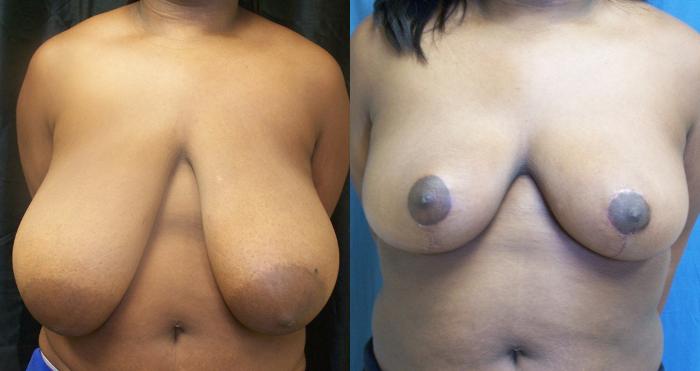 Before & After Breast Reduction Case 4478 View 1 View in Virginia Beach, VA