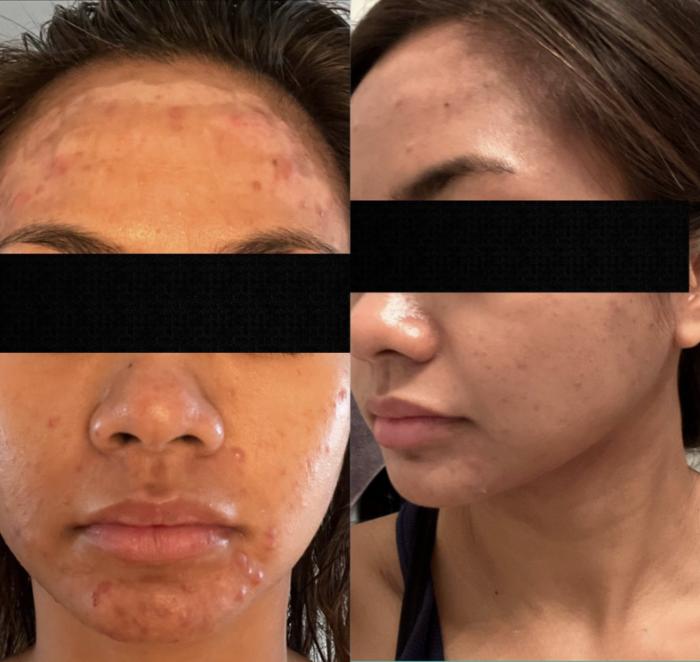 Before & After Chemical Peels & Facials Case 11 View 1 View in Virginia Beach, VA