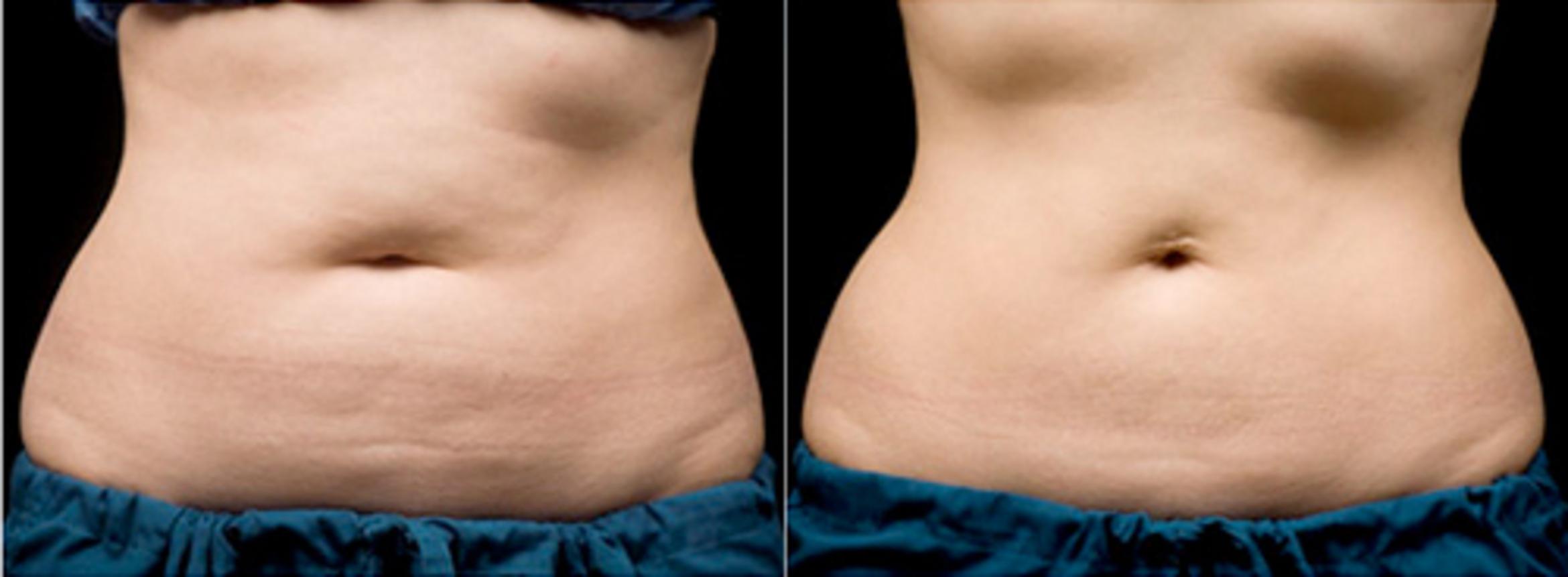 Before & After CoolSculpting® Case 2608 View 1 View in Virginia Beach, VA