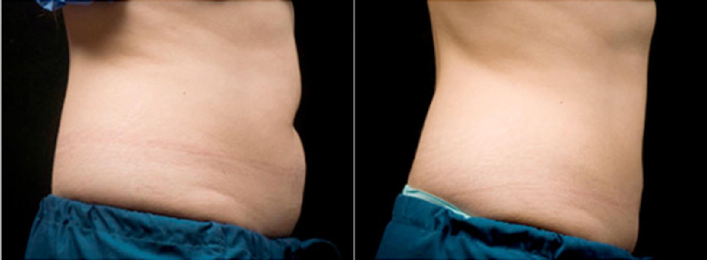 Before & After CoolSculpting® Case 2608 View 2 View in Virginia Beach, VA