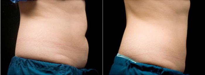 Before & After CoolSculpting® Case 2608 View 2 View in Virginia Beach, VA