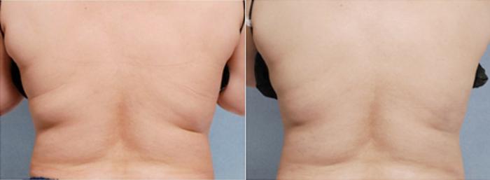 Before & After CoolSculpting® Case 2619 View 1 View in Virginia Beach, VA