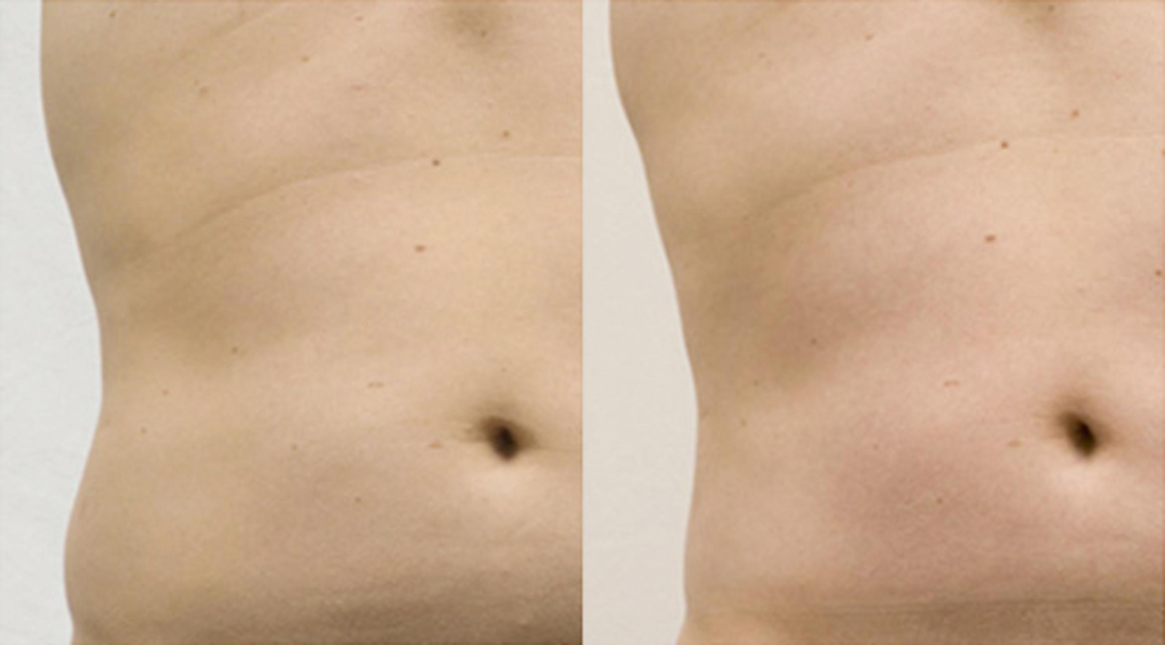 Before & After CoolSculpting® Case 2622 View 1 View in Virginia Beach, VA