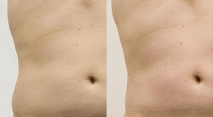 Before & After CoolSculpting® Case 2622 View 1 View in Virginia Beach, VA
