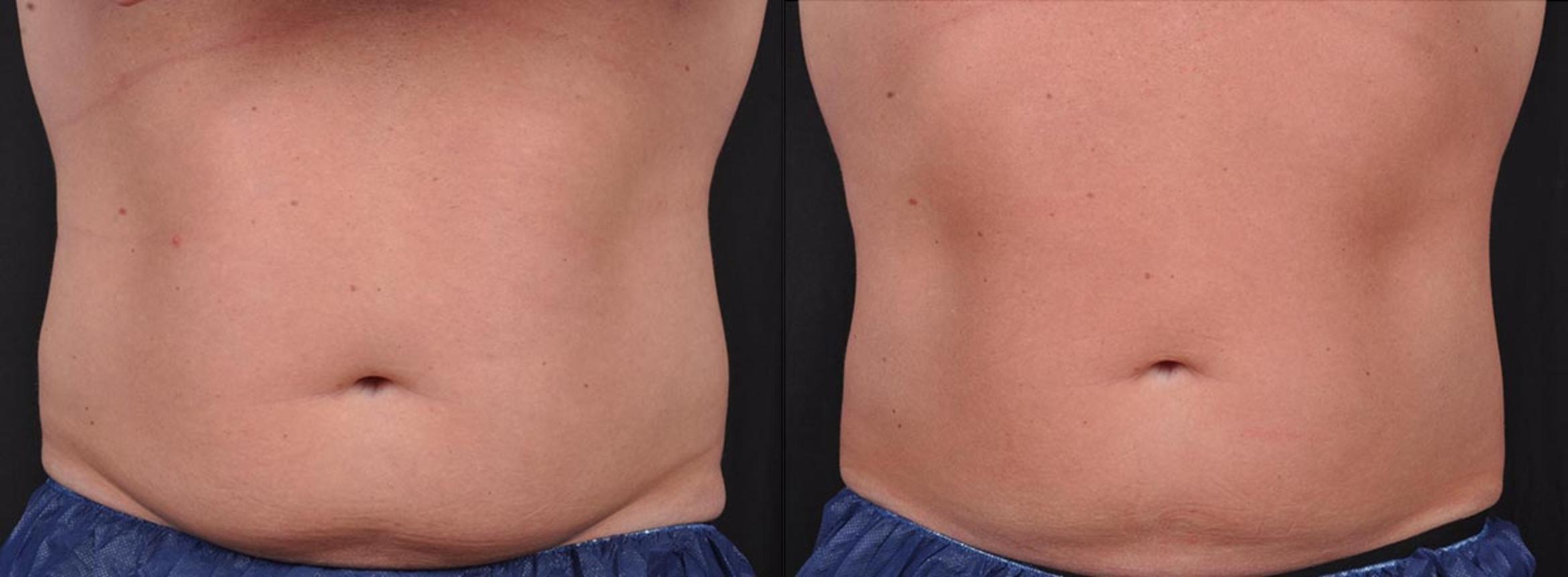 Before & After CoolSculpting® Elite Case 19105 View 1 View in Virginia Beach, VA