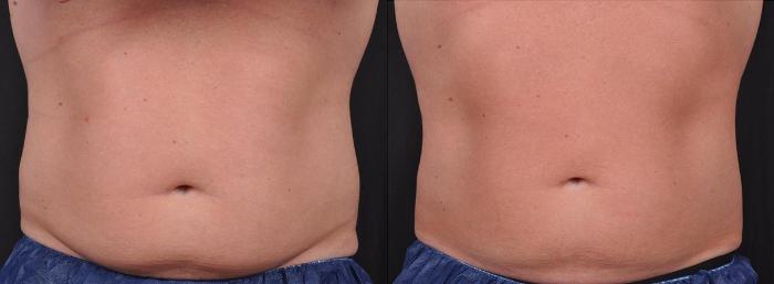 Before & After CoolSculpting® Elite Case 19105 View 1 View in Virginia Beach, VA
