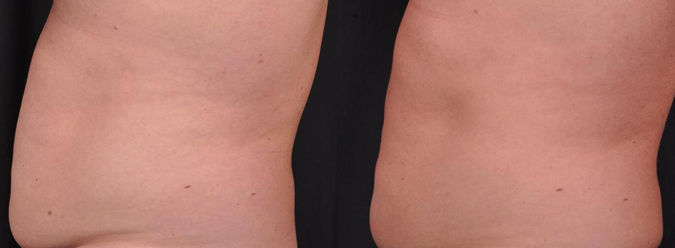 Before & After CoolSculpting® Elite Case 19105 View 2 View in Virginia Beach, VA