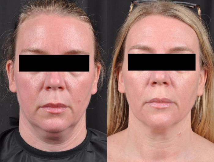 Before & After CoolSculpting® Elite Case 27 View 1 View in Virginia Beach, VA