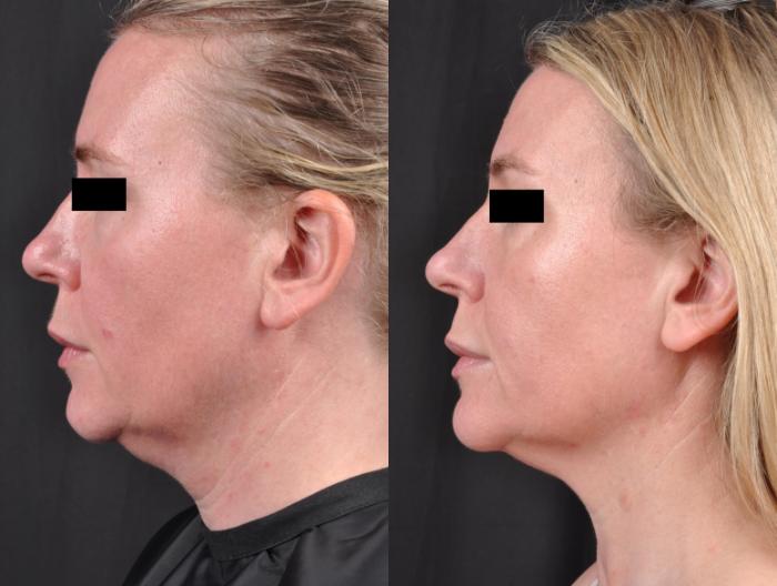 Before & After CoolSculpting® Elite Case 27 View 2 View in Virginia Beach, VA