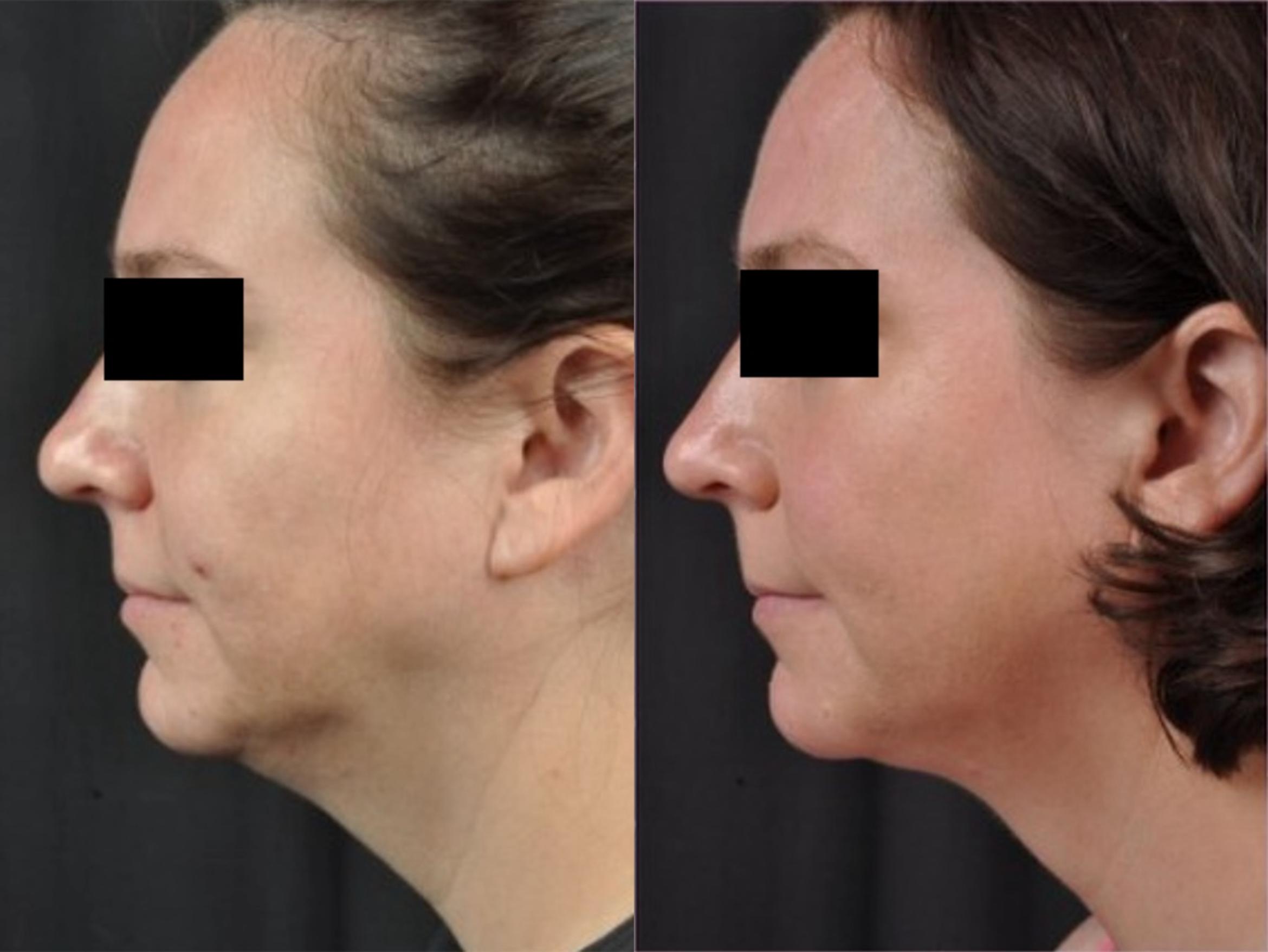 Before & After CoolSculpting® Elite Case 28275 View 1 View in Virginia Beach, VA