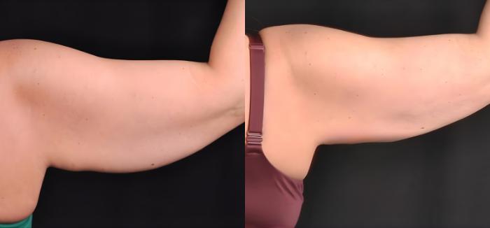 Before & After CoolSculpting® Elite Case 60632 Back View in Virginia Beach, VA