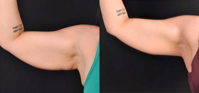 Before & After CoolSculpting® Elite Case 60632 Front View in Virginia Beach, VA