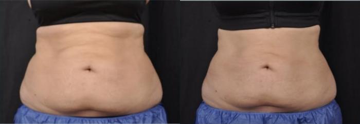 Before & After CoolSculpting® Elite Case 60668 Front View in Virginia Beach, VA
