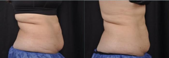 Before & After CoolSculpting® Elite Case 60668 Left Side View in Virginia Beach, VA