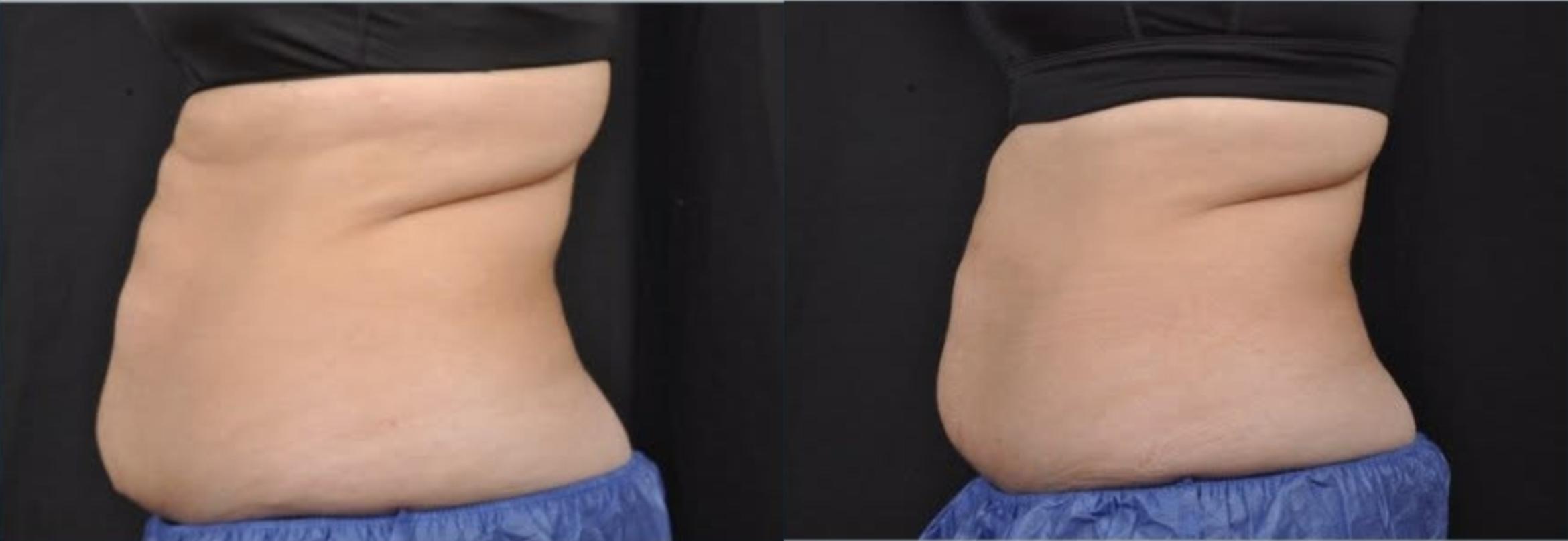 Before & After CoolSculpting® Elite Case 60668 Right Side View in Virginia Beach, VA