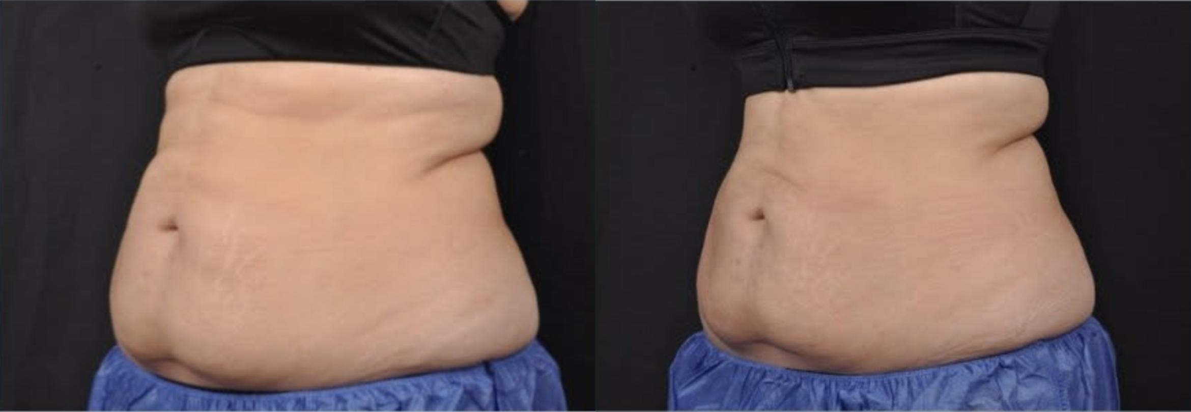 Before & After CoolSculpting® Elite Case 60668 Three-quarter (left) View in Virginia Beach, VA