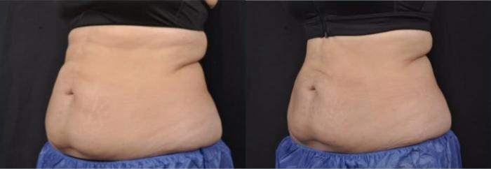 Before & After CoolSculpting® Elite Case 60668 Three-quarter (left) View in Virginia Beach, VA