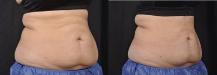 Before & After CoolSculpting® Elite Case 60668 Three-quarter (right) View in Virginia Beach, VA