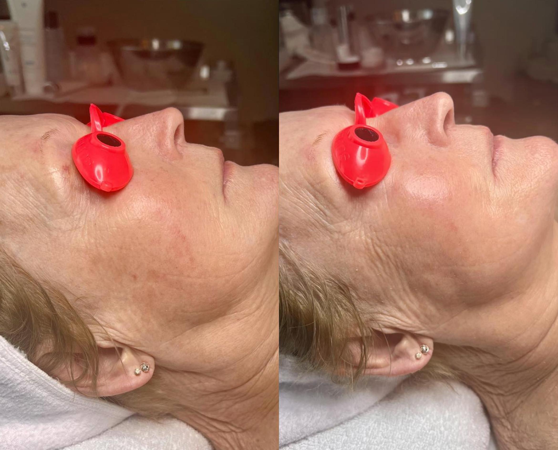Before & After Deep Pore Cleansing Facial Case 22814 View 1 View in Virginia Beach, VA