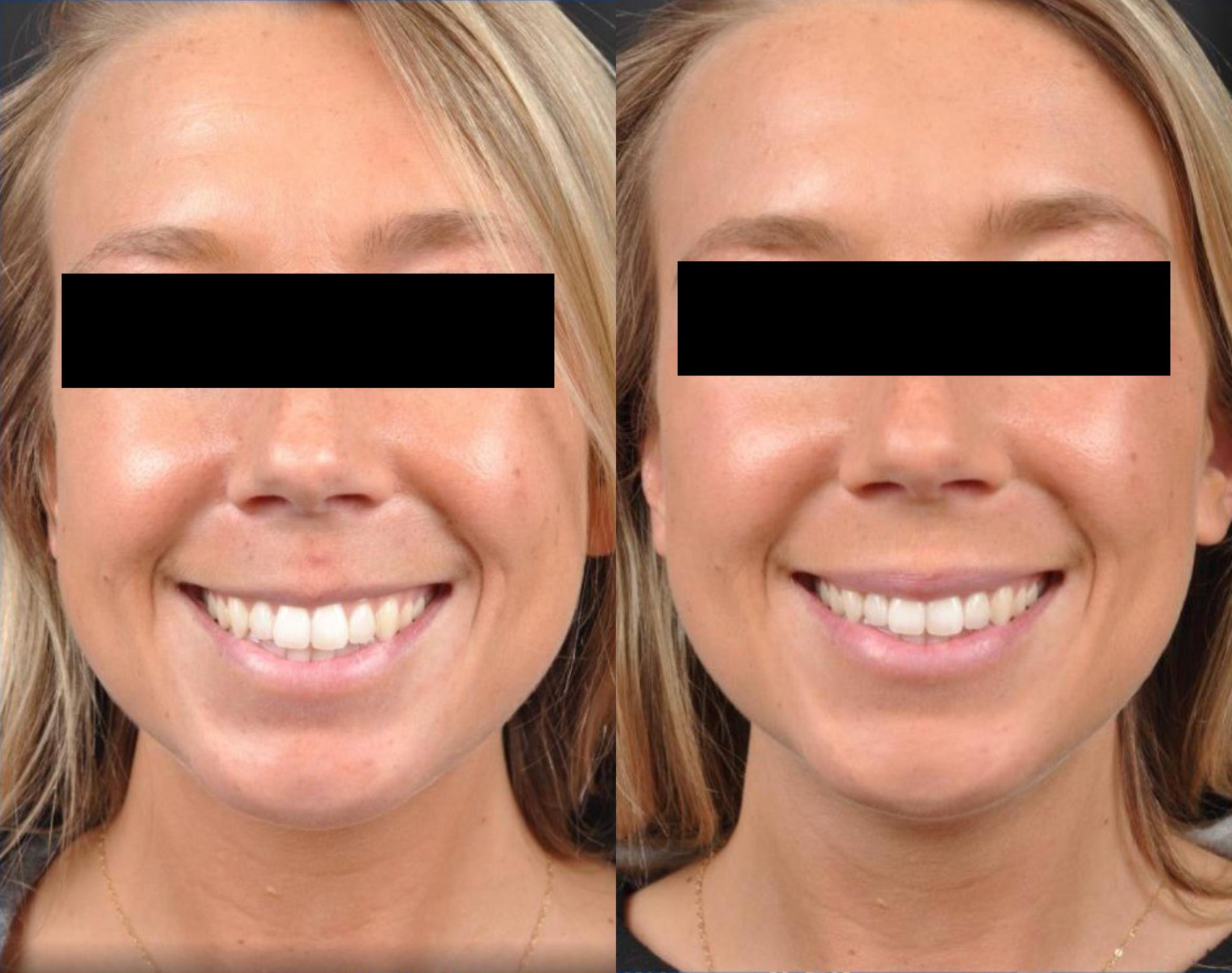 Before & After Dysport® Case 18 View 1 View in Virginia Beach, VA