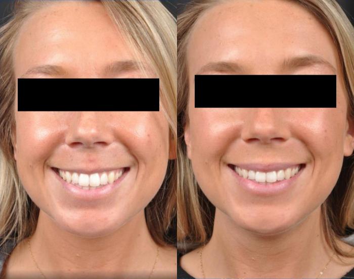 Before & After Dysport® Case 18 View 1 View in Virginia Beach, VA