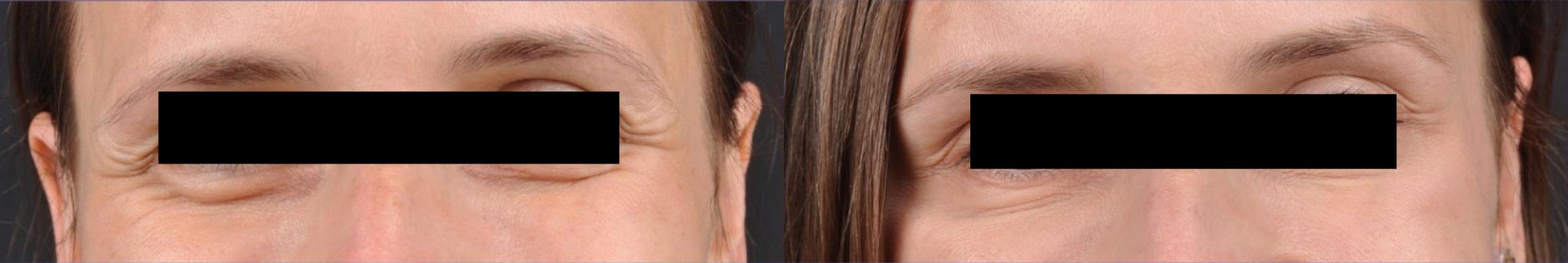 Before & After Dysport® Case 27536 View 1 View in Virginia Beach, VA