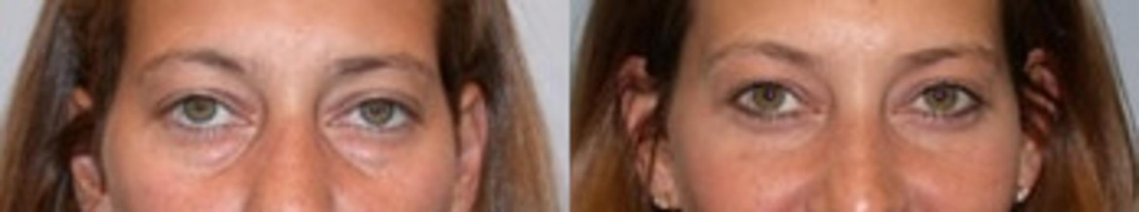 Before & After Eyelid Surgery Case 13 View 1 View in Virginia Beach, VA