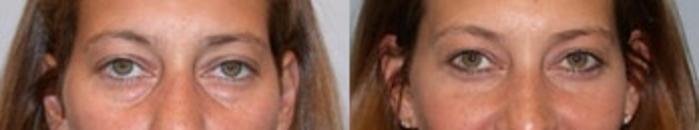Before & After Eyelid Surgery Case 13 View 1 View in Virginia Beach, VA