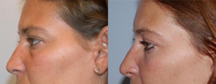 Before & After Eyelid Surgery Case 13 View 2 View in Virginia Beach, VA