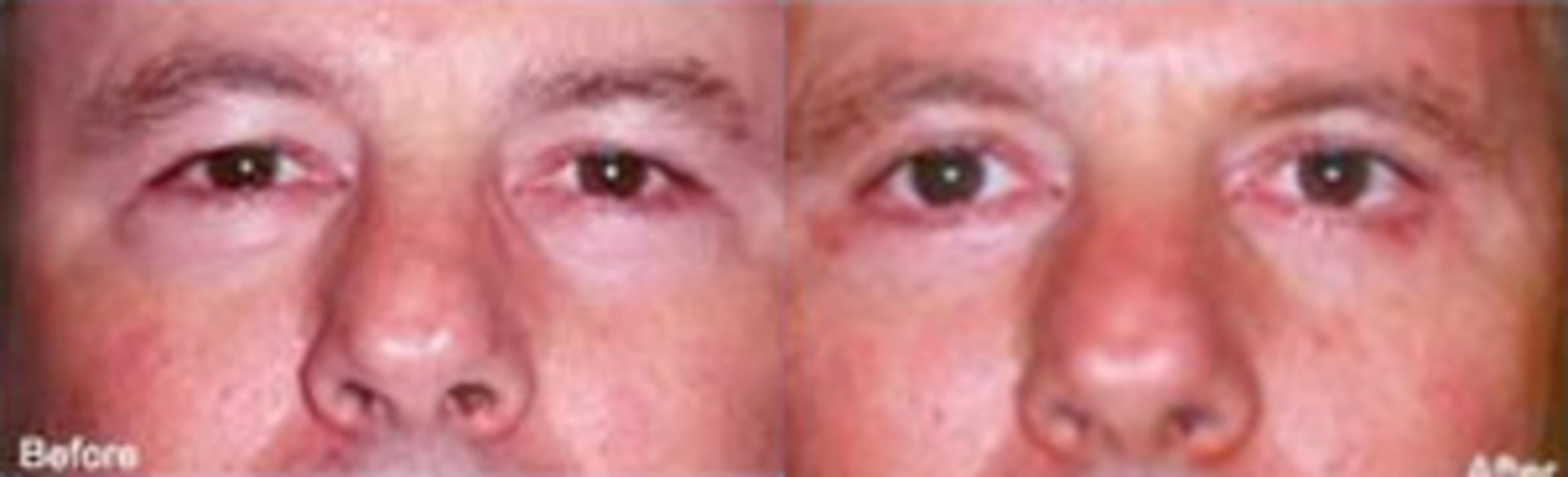 Before & After Eyelid Surgery Case 2 View 1 View in Virginia Beach, VA