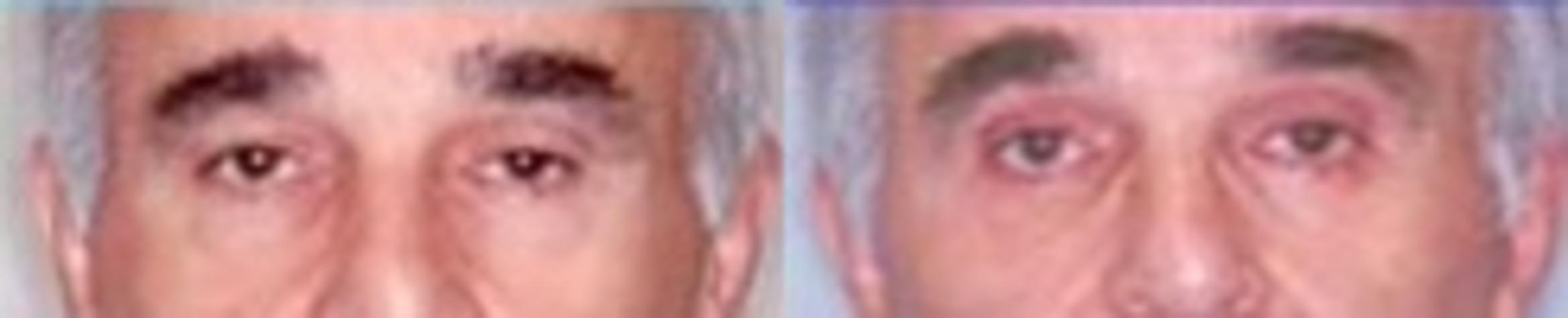 Before & After Eyelid Surgery Case 2598 View 1 View in Virginia Beach, VA