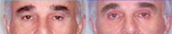Before & After Eyelid Surgery Case 2598 View 1 View in Virginia Beach, VA