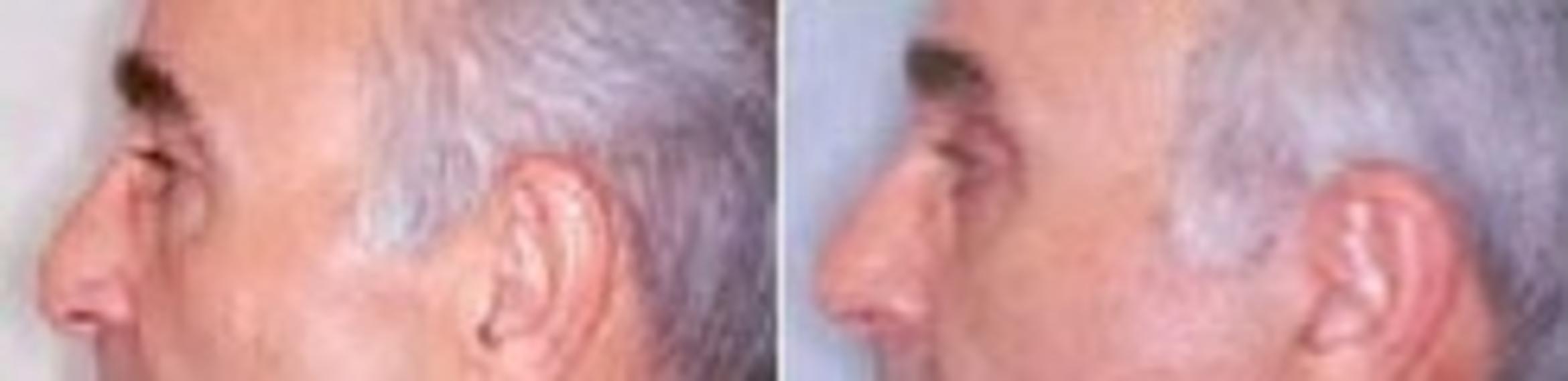 Before & After Eyelid Surgery Case 2598 View 2 View in Virginia Beach, VA