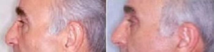 Before & After Eyelid Surgery Case 2598 View 2 View in Virginia Beach, VA