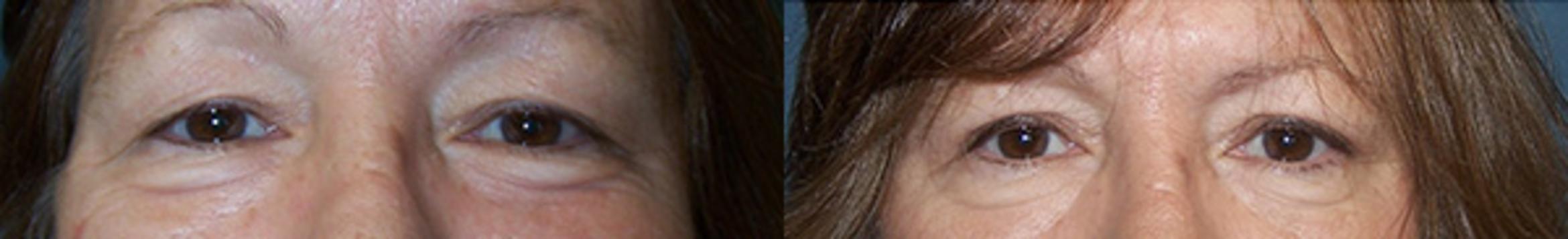 Before & After Eyelid Surgery Case 2733 View 1 View in Virginia Beach, VA