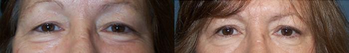 Before & After Eyelid Surgery Case 2733 View 1 View in Virginia Beach, VA
