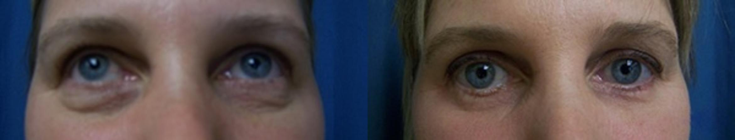 Before & After Eyelid Surgery Case 2878 View 2 View in Virginia Beach, VA