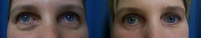 Before & After Eyelid Surgery Case 2878 View 2 View in Virginia Beach, VA