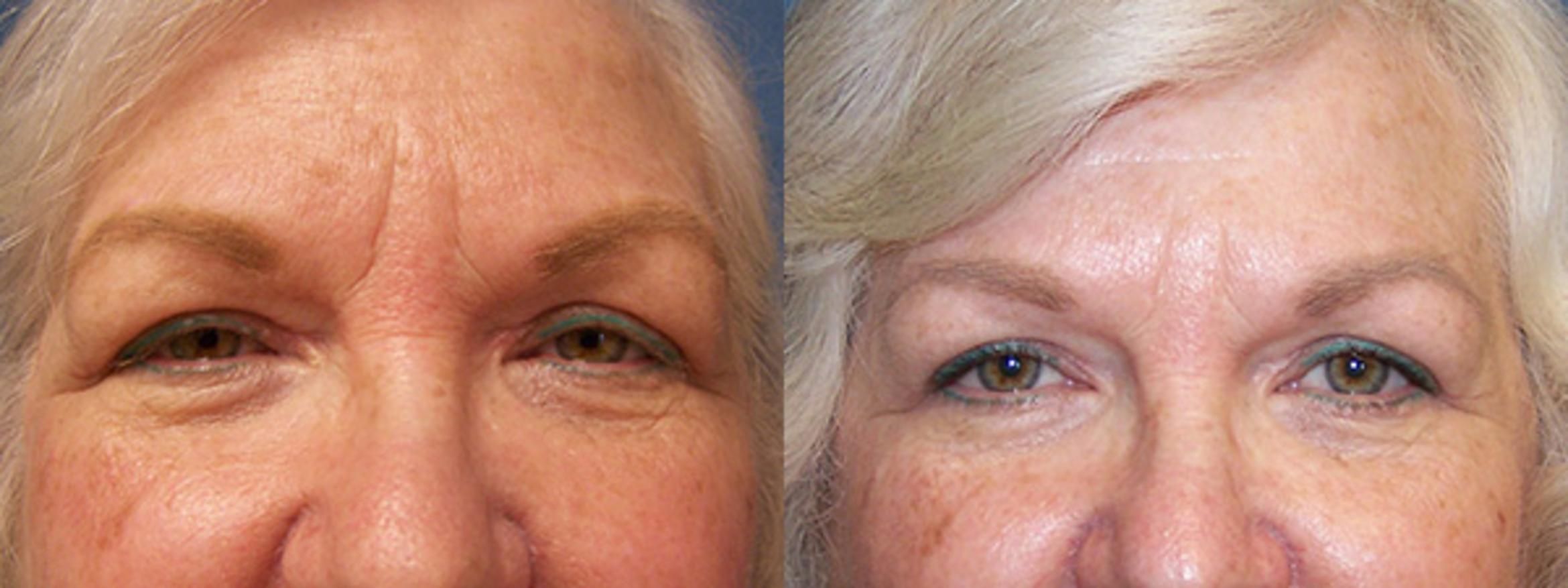 Before & After Eyelid Surgery Case 2883 View 1 View in Virginia Beach, VA