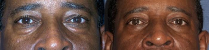 Before & After Eyelid Surgery Case 3223 View 1 View in Virginia Beach, VA