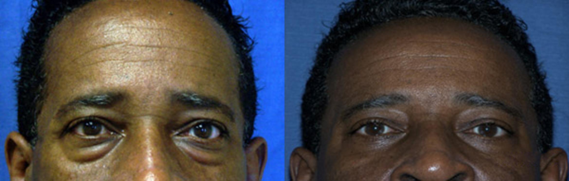Before & After Eyelid Surgery Case 3223 View 2 View in Virginia Beach, VA