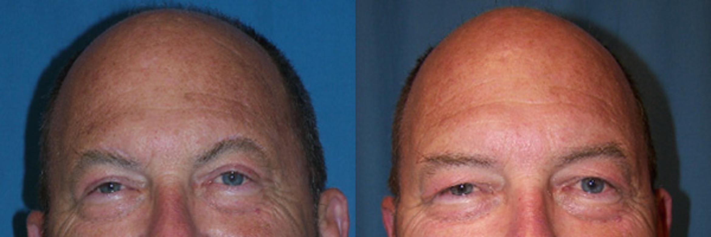 Before & After Eyelid Surgery Case 3235 View 1 View in Virginia Beach, VA