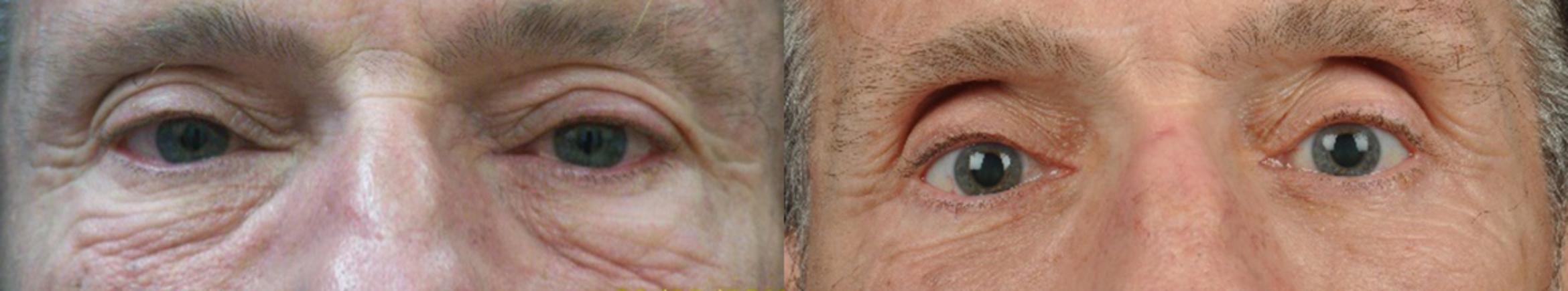 Before & After Eyelid Surgery Case 4459 View 1 View in Virginia Beach, VA