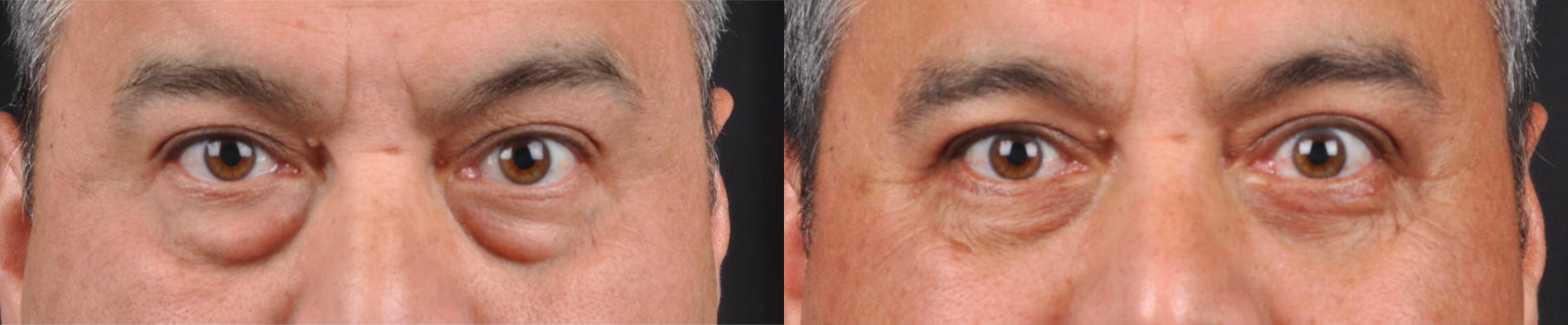 Before & After Eyelid Surgery Case 60629 Front View in Virginia Beach, VA